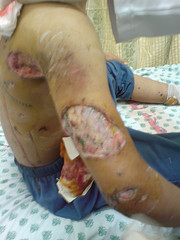 Chemical burns follwong Israeli bombings by ISM Palestine